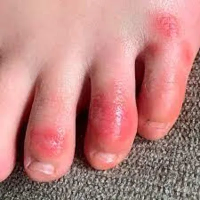 Covid toes: A perplexing medical finding in Covid 19