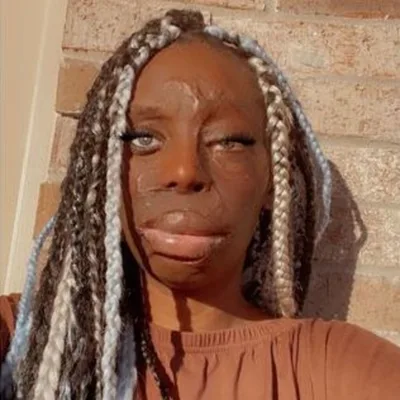 What's the story of your burn?