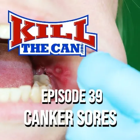 Navigating Canker Sores After Quitting Smokeless Tobacco